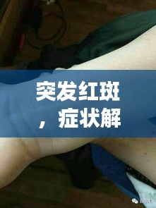 突发红斑，症状解析、诱因探究与应对之策