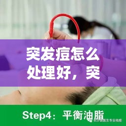 突发痘怎么处理好，突发痘痘急救法 