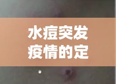 水痘突发疫情的定义，水痘发病情况 