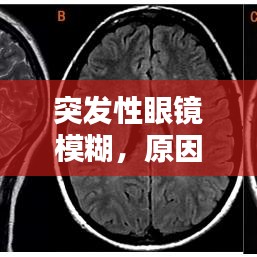 突发性眼镜模糊，原因解析、应对方法与预防策略